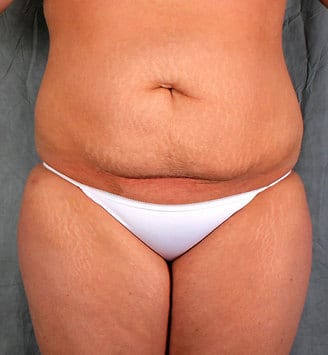 liposuction - patient 3917 - after 4 liposuction - patient 3917 - after 4