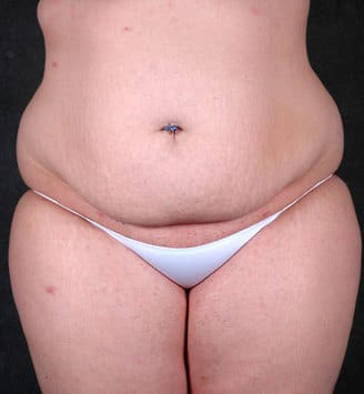 liposuction - patient 3917 - before 4 liposuction - patient 3917 - before 4