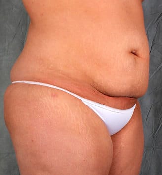 liposuction - patient 3917 - after 5 liposuction - patient 3917 - after 5