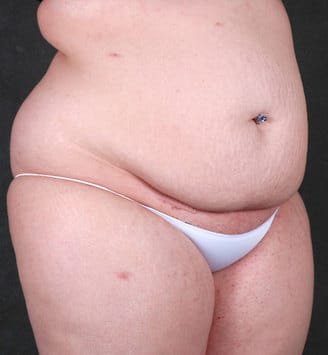 liposuction - patient 3917 - before 5 liposuction - patient 3917 - before 5
