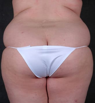 liposuction - patient 3917 - before 7 liposuction - patient 3917 - before 7