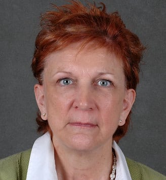 facelift - patient 5617 - after 1 facelift - patient 5617 - after 1