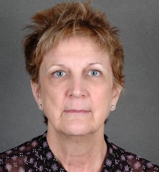 facelift - patient 5617 - before 1 facelift - patient 5617 - before 1