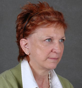facelift - patient 5617 - after 2 facelift - patient 5617 - after 2