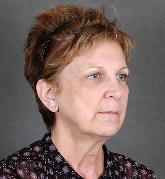 facelift - patient 5617 - before 2 facelift - patient 5617 - before 2