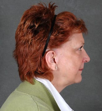 facelift - patient 5617 - after 3 facelift - patient 5617 - after 3