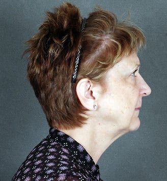 facelift - patient 5617 - before 3 facelift - patient 5617 - before 3