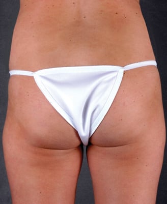 liposuction - patient 4039 - after 2 liposuction - patient 4039 - after 2