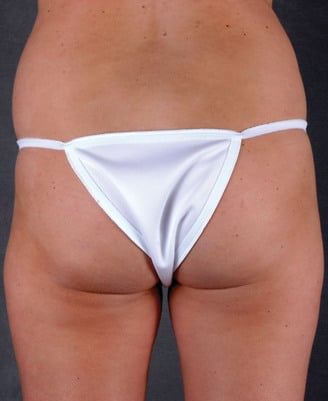 liposuction - patient 4039 - before 2 liposuction - patient 4039 - before 2