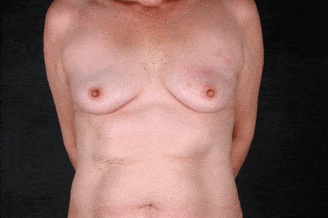 breast augmentation - patient 5064 - before 1 breast augmentation - patient 5064 - before 1