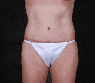 tummy tuck - patient 4960 - after 3 tummy tuck - patient 4960 - after 3