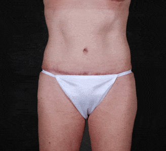 breast augmentation - patient 5064 - after 3 breast augmentation - patient 5064 - after 3