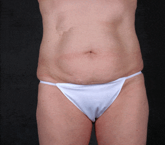breast augmentation - patient 5064 - before 3 breast augmentation - patient 5064 - before 3