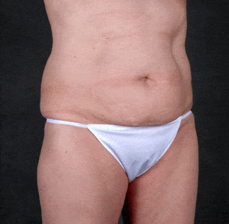 breast augmentation - patient 5064 - before 4 breast augmentation - patient 5064 - before 4