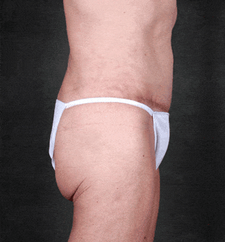 tummy tuck - patient 4960 - after 5 tummy tuck - patient 4960 - after 5