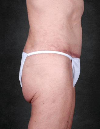breast augmentation - patient 5064 - after 5 breast augmentation - patient 5064 - after 5