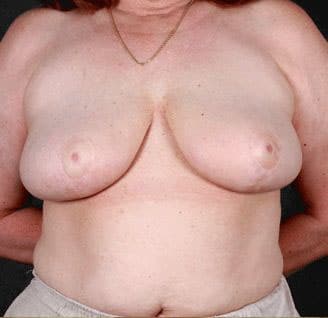 breast reduction - patient 6000 - after 1 breast reduction - patient 6000 - after 1