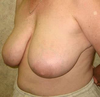 breast reduction - patient 6000 - before 2 breast reduction - patient 6000 - before 2