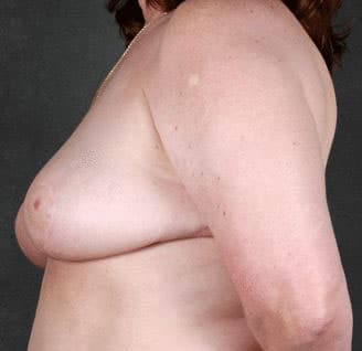 breast reduction - patient 6000 - after 3 breast reduction - patient 6000 - after 3