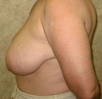 breast reduction - patient 6000 - before 3 breast reduction - patient 6000 - before 3