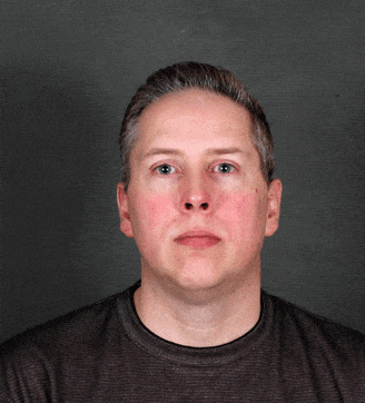 genioplasty - patient 5711 - before 1 genioplasty - patient 5711 - before 1