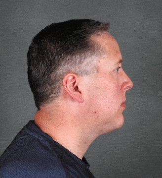 genioplasty - patient 5711 - after 3 genioplasty - patient 5711 - after 3