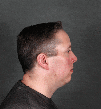 genioplasty - patient 5711 - before 3 genioplasty - patient 5711 - before 3