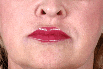 juvéderm - patient 6079 - after 1 juvéderm - patient 6079 - after 1