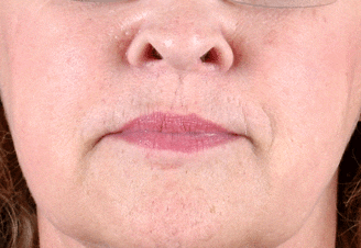 juvéderm - patient 6079 - before 1 juvéderm - patient 6079 - before 1