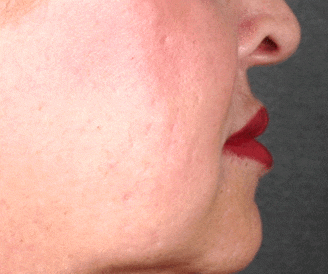 juvéderm - patient 6079 - after 2 juvéderm - patient 6079 - after 2