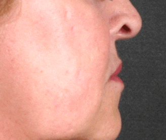 juvéderm - patient 6079 - before 2 juvéderm - patient 6079 - before 2
