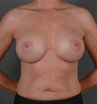 breast augmentation - patient 3997 - after 1 breast augmentation - patient 3997 - after 1