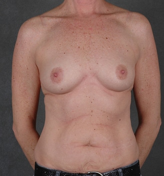 breast augmentation - patient 3997 - before 1 breast augmentation - patient 3997 - before 1