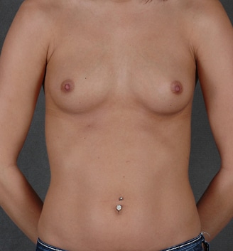 breast augmentation - patient 4103 - before 1 breast augmentation - patient 4103 - before 1