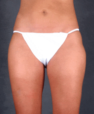 liposuction - patient 3801 - after 1 liposuction - patient 3801 - after 1