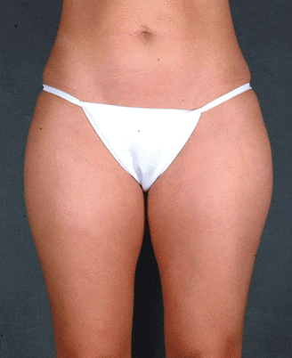 liposuction - patient 3801 - before 1 liposuction - patient 3801 - before 1