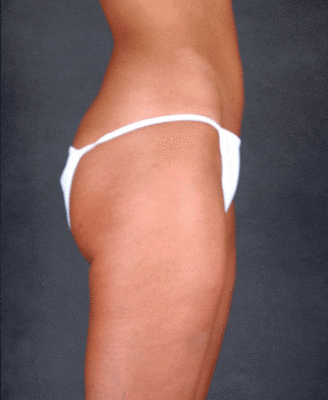 liposuction - patient 3801 - after 2 liposuction - patient 3801 - after 2