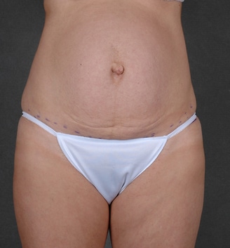 mommy makeover - patient 4499 - before 1 mommy makeover - patient 4499 - before 1
