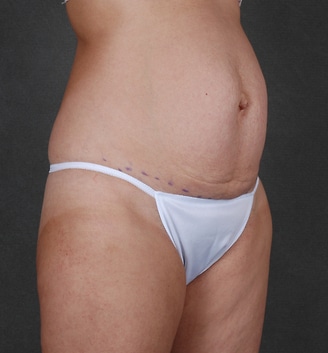 mommy makeover - patient 4499 - before 2 mommy makeover - patient 4499 - before 2
