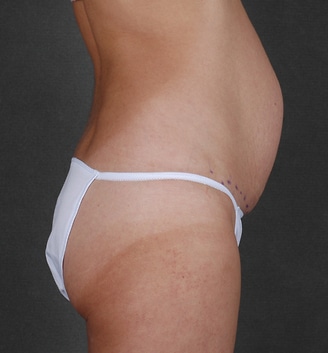 mommy makeover - patient 4499 - before 3 mommy makeover - patient 4499 - before 3