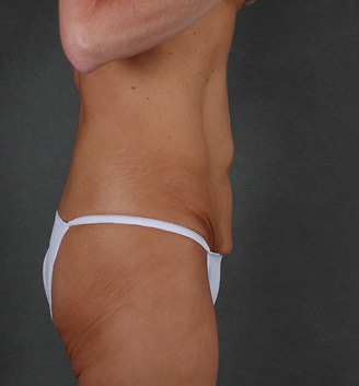 breast augmentation - patient 3855 - before 5 breast augmentation - patient 3855 - before 5