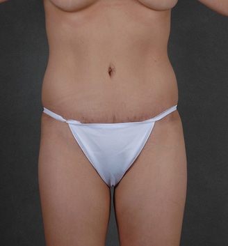 mommy makeover - patient 4436 - after 1 mommy makeover - patient 4436 - after 1