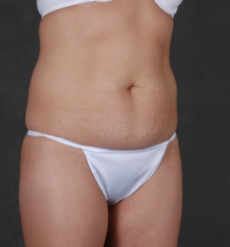 mommy makeover - patient 4436 - before 2 mommy makeover - patient 4436 - before 2