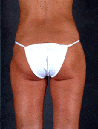 liposuction - patient 3801 - after 3 liposuction - patient 3801 - after 3
