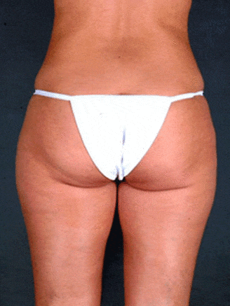 liposuction - patient 3801 - before 3 liposuction - patient 3801 - before 3