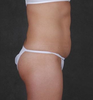 mommy makeover - patient 4436 - before 3 mommy makeover - patient 4436 - before 3