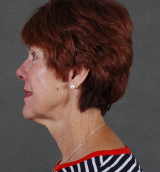 juvéderm - patient 6072 - after 3 juvéderm - patient 6072 - after 3
