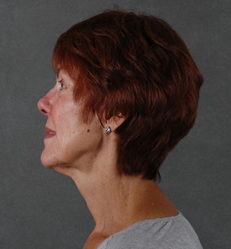 juvéderm - patient 6072 - before 3 juvéderm - patient 6072 - before 3