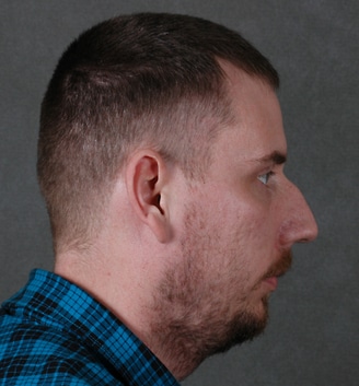 rhinoplasty - patient 5756 - before 2 rhinoplasty - patient 5756 - before 2