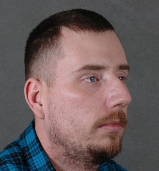 rhinoplasty - patient 5756 - before 3 rhinoplasty - patient 5756 - before 3